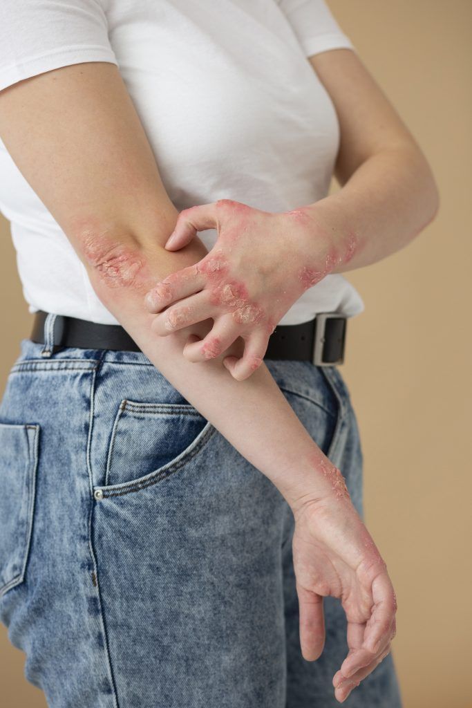 Dermatitis estrés
