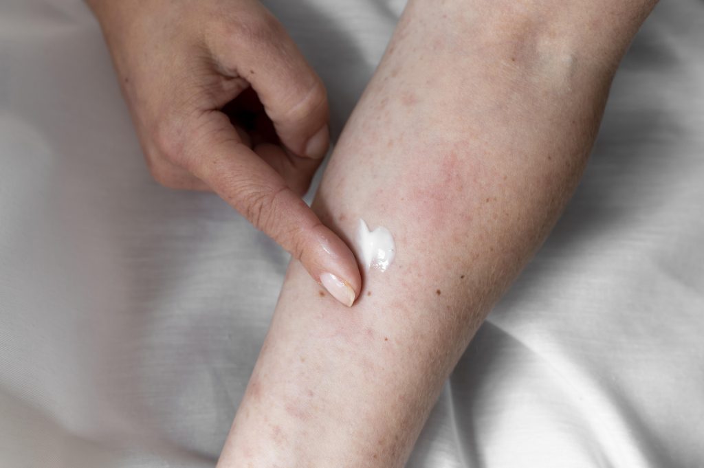 Dermatitis seborreica estrés